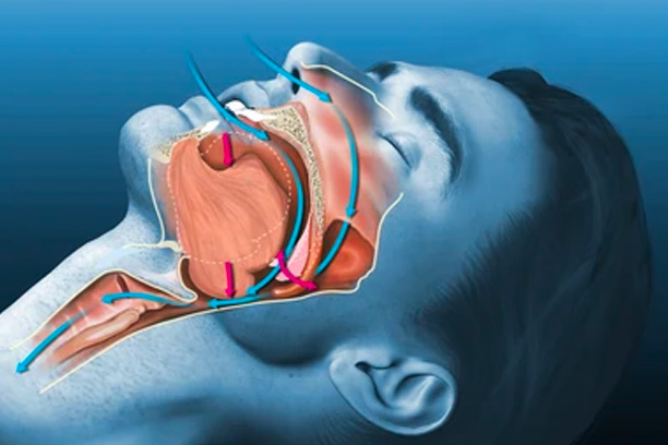 Sleep apnea diagram